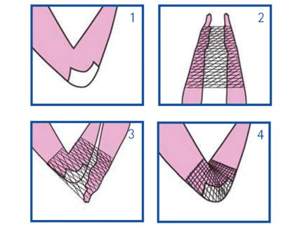 RETE TUBOLARE ELASTICA - calibro C per braccio e spalla - latex free